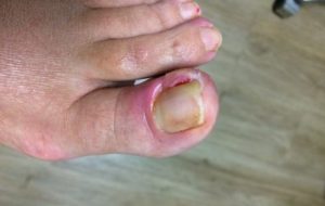 Ongle incarné — Soins des pieds Kathy Ouellet Terrebonne