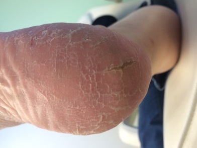 talons crevassés que faire causes prévention Terrebonne