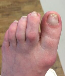 Ongle mal taillé avant soin — Soins des pieds Kathy Ouellet Terrebonne