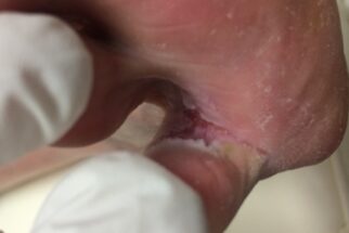 Pied d'athlète — Soins des pieds Kathy Ouellet Terrebonne