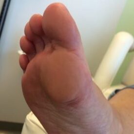 Callosité après soin — Soins des pieds Kathy Ouellet Terrebonne